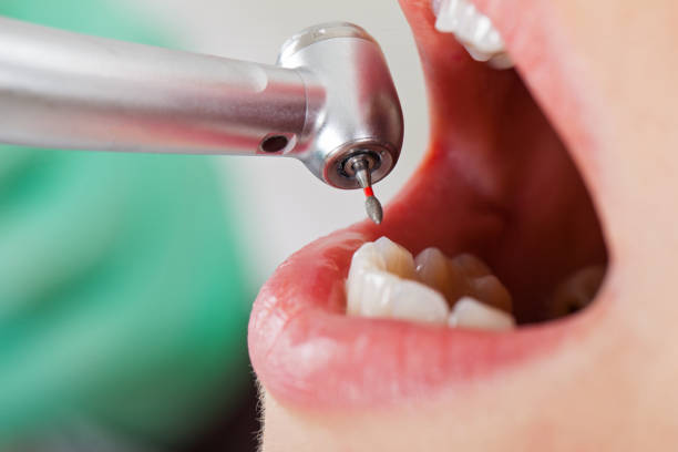 Best Emergency Root Canal Treatment in East Pepperell, MA